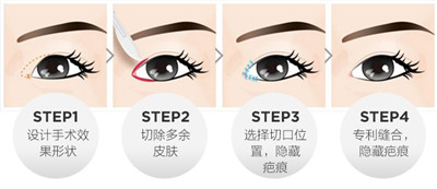 开内眼角